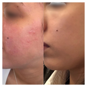 Traitement de l’acné inflammatoire ALAfast 1