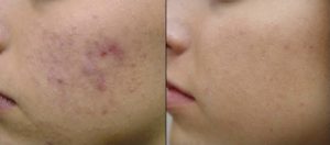 Traitement de l’acné inflammatoire ALAfast 2