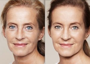 resultat-restylane-skinbooster