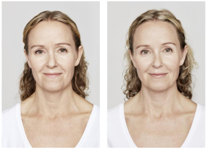 skinboosters